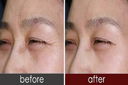 魚(yú)尾紋去除