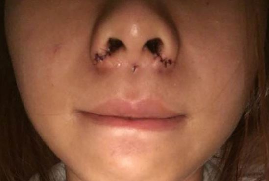 鼻孔大怎么辦？能做手術(shù)縮小嗎？