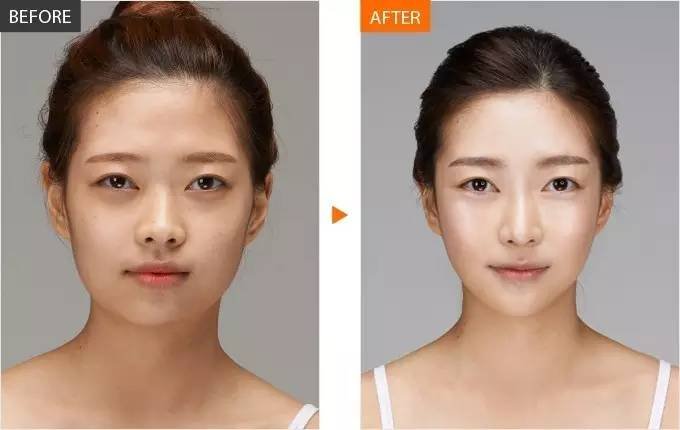 假體隆鼻術(shù)前有什么注意事項(xiàng)？