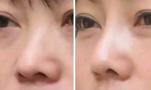 隆鼻后修復(fù)手術(shù)恢復(fù)時(shí)間會(huì)更長(zhǎng)嗎？