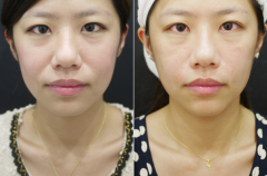 去法令紋有什么好辦法？