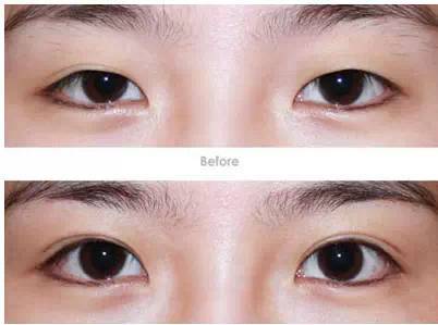 上眼瞼下垂手術(shù)多少錢？