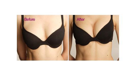 自體脂肪隆胸要注意什么？