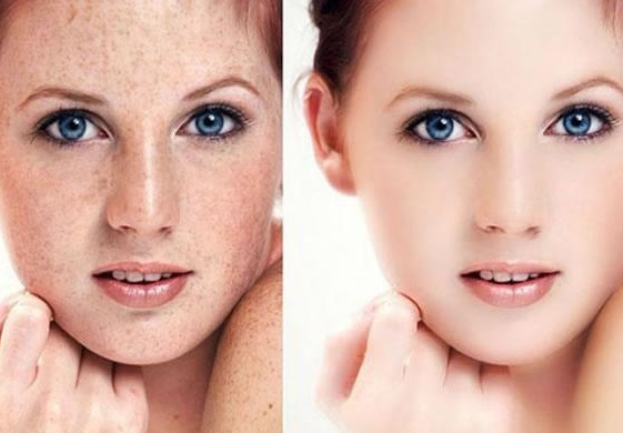 黃褐斑的形成是因為什么？