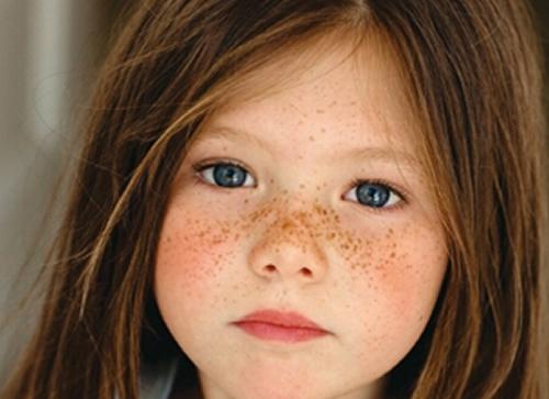 黃褐斑的形成是因為什么？