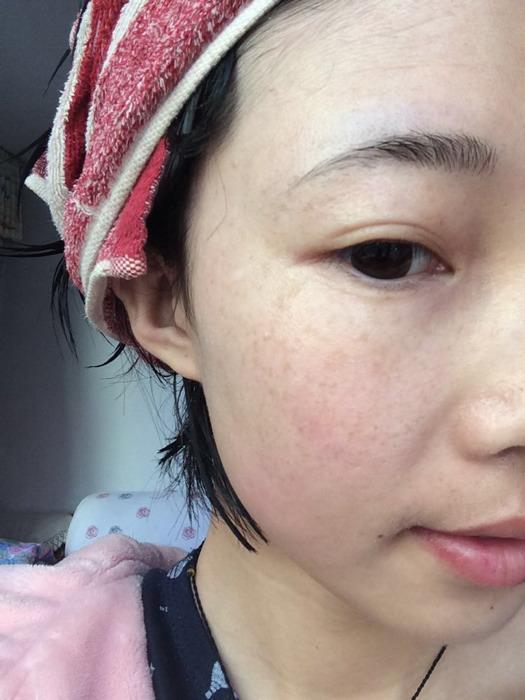 激光祛斑痛不痛？