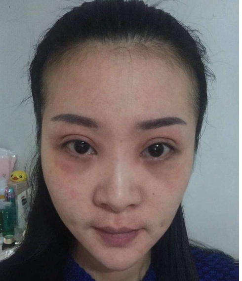 激光祛斑一次多少錢？