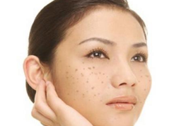 激光祛斑一次多少錢？