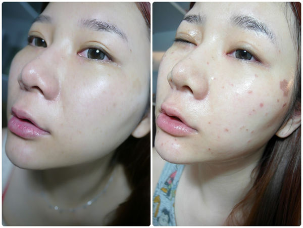 激光能祛斑嗎？