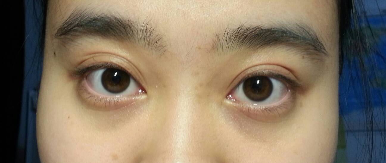 黑眼圈怎么消除？