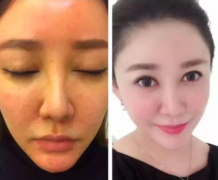 激光祛斑有效嗎？