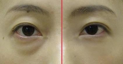 如何去除黑眼圈有妙招！