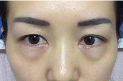 如何消除眼袋才有效？