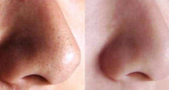 鼻子太大想做手術(shù)縮小鼻子，可行嗎？