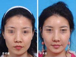 鼻子太大想做手術(shù)縮小鼻子，可行嗎？