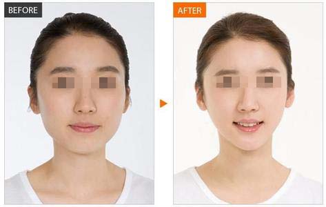 重慶改臉型價格是多少?