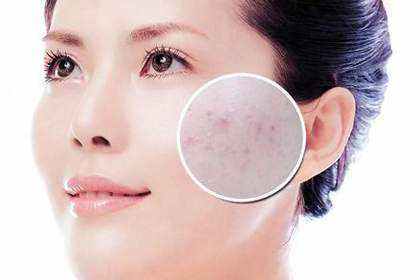 臉上長痘怎么辦？