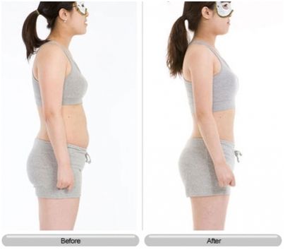 腹部吸脂手術(shù)后注意什么？