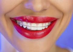 門牙矯正怎么樣？