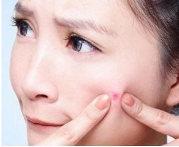 上海怎么祛痘??？