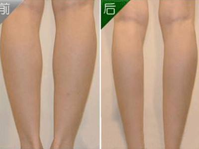 吸脂減肥手術(shù)要注意什么？