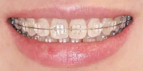 牙齒矯正價(jià)格貴嗎？