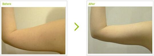 抽脂價(jià)格是多少？