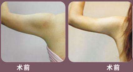 抽脂價(jià)格是多少？