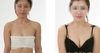 乳房再造手術(shù)有什么需要注意的？