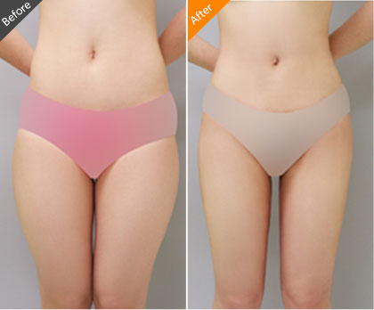 腿部抽脂會反彈嗎？