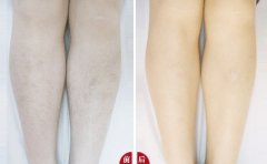 性脫毛對身體健康有危害嗎？