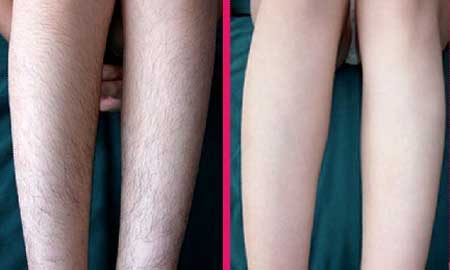 持久性脫毛對身體健康有危害嗎？