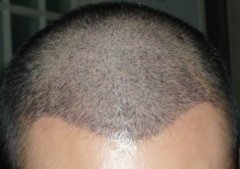 植發(fā)多少錢？