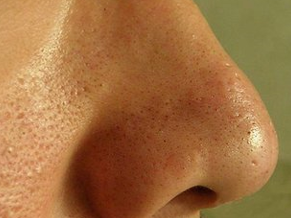 縮小毛孔的方法有什么？