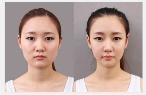 瘦臉的瘦臉效果好不好？