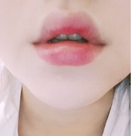 玻尿酸和膠原蛋白注射豐唇，哪個(gè)效果更好