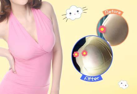 自體脂肪隆胸有什么要注意的？