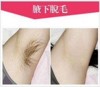 美萊冰點脫毛效果怎么樣？