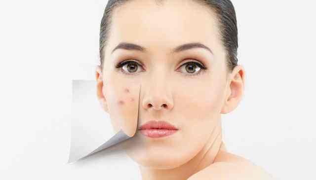 頑固痘印怎么消除？