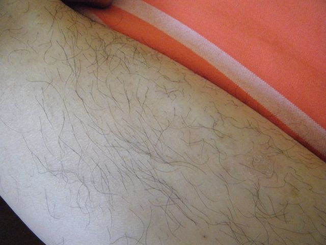 冰點(diǎn)脫毛多少錢?