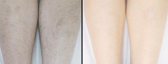 做激光脫毛疼不疼?