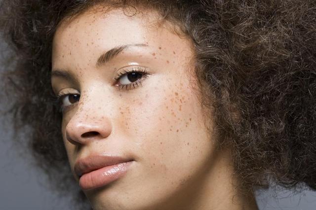 激光祛斑后，可以曬太陽嗎？