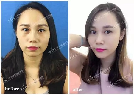 玻尿酸情人節(jié)特價(jià)？80元！