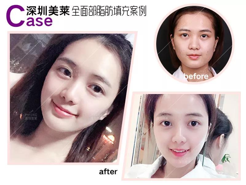 對比玻尿酸起脂肪填充更危險，為什么醫(yī)師還要推薦它？