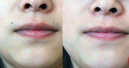 昆明激光點痣的價格多少？