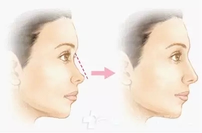 南京假體隆鼻手術(shù)一般需要多少錢？