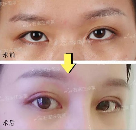 明星的眼和鼻，術(shù)后半個(gè)月Get專業(yè)混血臉！可萌可酷美翻了~