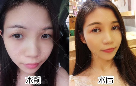 天生雙眼皮卻不好看？原因原來(lái)出在這！