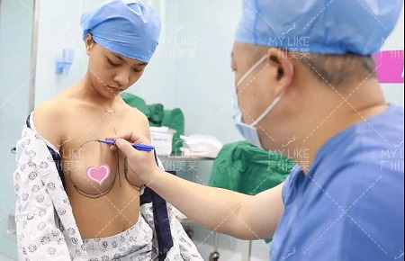 噴鼻血！34C罩杯的細腿精，抽了200ml脂肪隆胸！