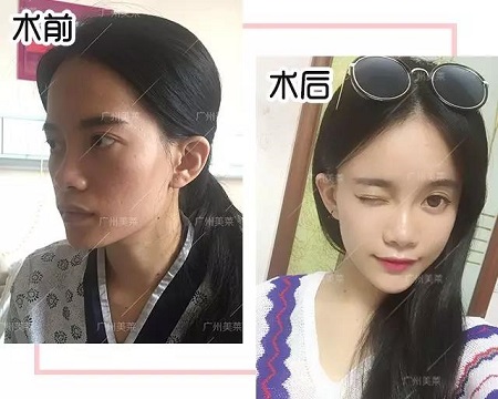 脂肪填一填，臉竟從“喪到爆”變“萌出血”！